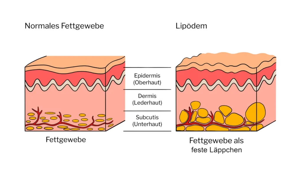 Entstehung Lipödem Darstellung